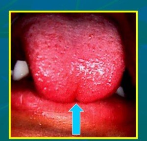 Nežymiai įskeltas liežuvio galiukas. Šis mikroskopinis įskilimas jau yra diagnozės požymis 